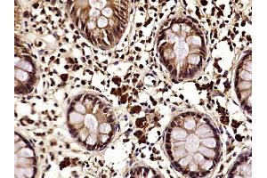 Paraformaldehyde-fixed, paraffin embedded human colon cancer, Antigen retrieval by boiling in sodium citrate buffer (pH6) for 15min, Block endogenous peroxidase by 3% hydrogen peroxide for 30 minutes,  Blocking buffer (normal goat serum) at 37°C for 20min, Antibody incubation with NDRG1 (Thr346) Polyclonal Antibody at 1:400 overnight at 4°C, followed by a conjugated secondary and DAB staining. (NDRG1 抗体  (pThr346))