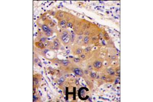 Formalin-fixed and paraffin-embedded human hepatocellular carcinoma reacted with NNMT polyclonal antibody  , which was peroxidase-conjugated to the secondary antibody, followed by DAB staining. (NNMT 抗体  (AA 77-106))
