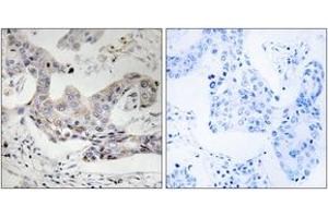 Immunohistochemistry analysis of paraffin-embedded human breast carcinoma tissue, using ALDH3B1 Antibody. (ALDH3B1 抗体  (AA 51-100))