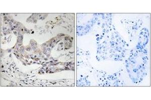 Immunohistochemistry analysis of paraffin-embedded human breast carcinoma tissue, using ALDH3B1 Antibody.