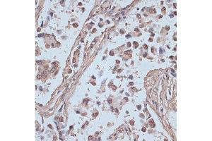 Immunohistochemistry of paraffin-embedded human lung cancer using SNW1 antibody (ABIN7270386) at dilution of 1:100 (40x lens). (SNW1 抗体  (AA 300-536))