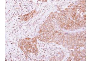 IHC-P Image Immunohistochemical analysis of paraffin-embedded human breast cancer, using GSPT1, antibody at 1:500 dilution. (GSPT1 抗体)