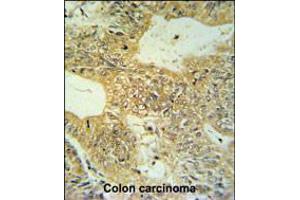 CLDN23 Antibody IHC analysis in formalin fixed and paraffin embedded colon carcinoma followed by peroxidase conjugation of the secondary antibody and DAB staining. (Claudin 23 抗体  (C-Term))