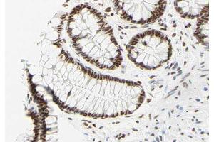 ABIN6269058 at 1/200 staining human colon carcinoma tissue sections by IHC-P.