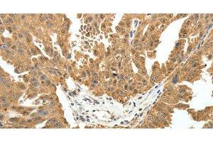 Immunohistochemistry of paraffin-embedded Human ovarian cancer using PTCH1 Polyclonal Antibody at dilution of 1:50 (Patched 1 抗体)