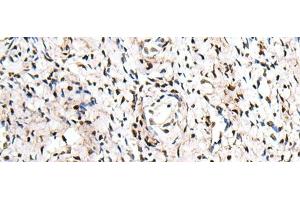 Immunohistochemistry of paraffin-embedded Human cervical cancer tissue using ZNF207 Polyclonal Antibody at dilution of 1:30(x200) (ZNF207 抗体)