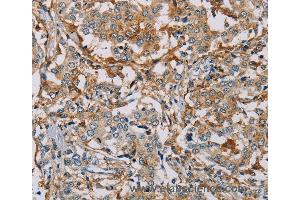 Immunohistochemistry of Human liver cancer using MSR1 Polyclonal Antibody at dilution of 1:30 (Macrophage Scavenger Receptor 1 抗体)