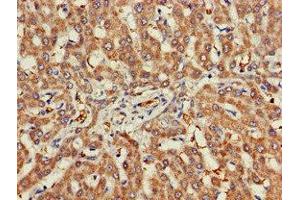 Immunohistochemistry of paraffin-embedded human liver cancer using ABIN7142959 at dilution of 1:100 (CHRNB1 抗体  (AA 24-244))