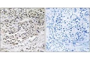 Immunohistochemistry analysis of paraffin-embedded human breast carcinoma tissue, using AZI1 Antibody. (AZI1 抗体  (AA 311-360))