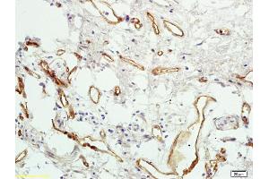 Formalin-fixed and paraffin embedded human colon carcinoma labeled with Rabbit Anti PAR4 Polyclonal Antibody, Unconjugated (ABIN673224) at 1:200 followed by conjugation to the secondary antibody and DAB staining (F2RL3 抗体  (AA 320-343))