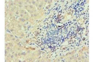 Immunohistochemistry of paraffin-embedded human liver cancer using ABIN7156754 at dilution of 1:100