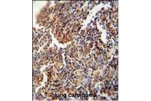 HFM1 antibody (C-term) (ABIN654571 and ABIN2844275) immunohistochemistry analysis in formalin fixed and paraffin embedded human lung carcinoma followed by peroxidase conjugation of the secondary antibody and DAB staining. (HFM1 抗体  (C-Term))