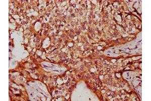 IHC image of ABIN7175349 diluted at 1:300 and staining in paraffin-embedded human cervical cancer performed on a Leica BondTM system. (Valyl-tRNA Synthetase 2, Mitochondrial (VARS2) (AA 830-981) 抗体)