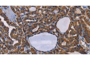 Immunohistochemistry of paraffin-embedded Human thyroid cancer tissue using GRK3 Polyclonal Antibody at dilution 1:50 (ADRBK2 抗体)