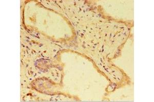 Immunohistochemistry of paraffin-embedded human prostate cancer using ABIN7168303 at dilution of 1:100 (RTF1 抗体  (AA 620-670))