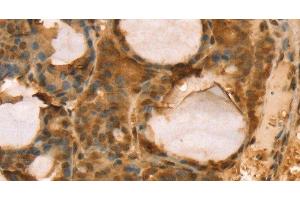 Immunohistochemistry of paraffin-embedded Human thyroid cancer using TAF11 Polyclonal Antibody at dilution of 1:40 (TAF11 抗体)
