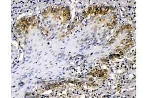 IHC testing of FFPE human esophageal squamous cancer with Cytokeratin 14 antibody at 1ug/ml.