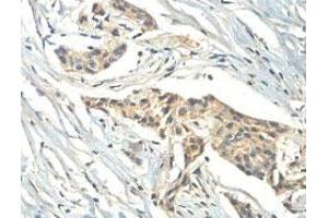 Immunohistochemical analysis of paraffin-embedded human breast carcinoma showing cytoplasmic staining with ZC3H11A polyclonal antibody  at a 1 : 100 dilution. (ZC3H11A 抗体  (AA 332-585))