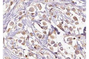 ABIN6277339 at 1/100 staining Human breast cancer tissue by IHC-P. (PDCD10 抗体  (Internal Region))