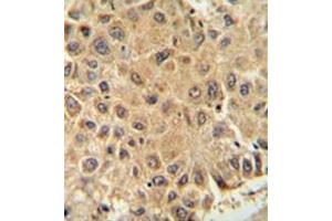 Immunohistochemistry analysis in formalin fixed and paraffin embedded human prostate carcinoma reacted with ISCA2 / HBLD1 Antibody (Center) followed which was  peroxidase conjugated to the secondary antibody and followed by DAB staining. (ISCA2 抗体  (Middle Region))