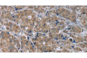 Immunohistochemistry of paraffin-embedded Human breast cancer using GABRB1 Polyclonal Antibody at dilution of 1:50 (GABRB1 抗体)