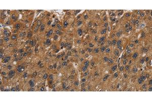 Immunohistochemistry of paraffin-embedded Human gastric cancer using ITGB7 Polyclonal Antibody at dilution of 1:40 (Integrin beta 7 抗体)