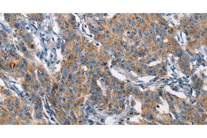 Immunohistochemistry of paraffin-embedded Human gastic cancer using CHMP1A Polyclonal Antibody at dilution of 1:60 (CHMP1A 抗体)