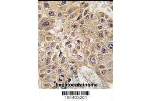 Formalin-fixed and paraffin-embedded human hepatocarcinoma tissue reacted with AMFR Antibody , which was peroxidase-conjugated to the secondary antibody, followed by DAB staining. (GPI 抗体  (AA 571-601))