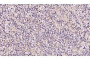ABIN6273101 at 1/100 staining Human lymph cancer tissue by IHC-P. (CKMT1 抗体  (N-Term))