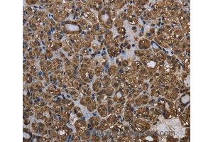 Immunohistochemistry of Human thyroid cancer using GSTP1 Polyclonal Antibody at dilution of 1:60 (GSTP1 抗体)