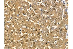 ABIN6265219 and ABIN6268746 at 1/100 staining Human liver cancer and adjacent normal tissues by IHC-P.