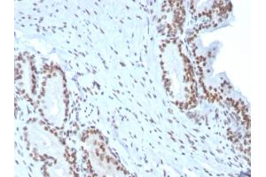 Formalin-fixed, paraffin-embedded human Prostate Carcinoma stained with BMI1 Mouse Monoclonal Antibody (BMI1/2823).