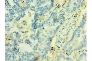 Immunohistochemistry of paraffin-embedded human lung cancer using ABIN7171227 at dilution of 1:100 (Syntaxin 12 抗体  (AA 1-250))