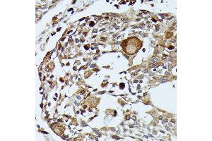 Immunohistochemistry of paraffin-embedded human esophageal cancer using MEKK3 antibody (ABIN7268652) at dilution of 1:100 (40x lens). (MAP3K3 抗体  (AA 1-220))