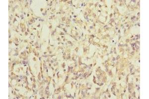 Immunohistochemistry of paraffin-embedded human gastric cancer using ABIN7142352 at dilution of 1:100 (MRPL12 抗体  (AA 1-198))