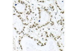 Immunohistochemistry of paraffin-embedded human gastric cancer using BCCIP antibody. (BCCIP 抗体  (AA 1-314))