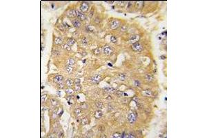 Formalin-fixed and paraffin-embedded human hepatocarcinoma tissue reacted with AP14345PU-N IGFBP3 Antibody (N-term) which was peroxidase-conjugated to the secondary antibody, followed by DAB staining. (IGFBP3 抗体  (N-Term))