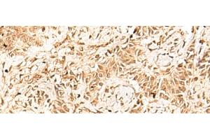Immunohistochemistry of paraffin-embedded Human ovarian cancer tissue using HNF4A Polyclonal Antibody at dilution of 1:40(x200) (HNF4A 抗体)