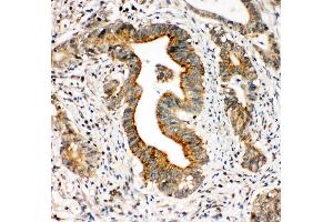 Anti-Integrin alpha 3 antibody, IHC(P) IHC(P): Human Intestinal Cancer Tissue (ITGA3 抗体  (N-Term))