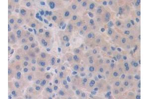 Detection of Slit1 in Human Liver cancer Tissue using Polyclonal Antibody to Slit Homolog 1 (Slit1) (SLIT1 抗体  (AA 647-835))