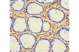 Immunohistochemistry of paraffin-embedded human gastric cancer using ABIN7153143 at dilution of 1:100 (CX3CL1 抗体  (AA 25-100))