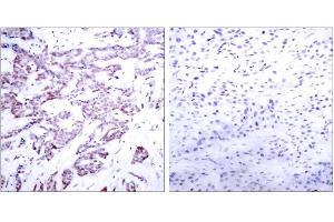 Immunohistochemical analysis of paraffin-embedded human breast carcinoma tissue using STAT6 (phospho-Thr645) antibody (E011051). (STAT6 抗体  (pThr645))