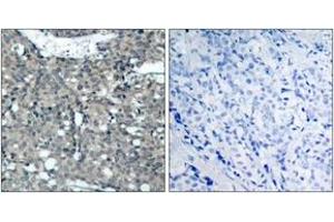 Immunohistochemistry analysis of paraffin-embedded human breast carcinoma tissue, using Paxillin (Ab-118) Antibody. (Paxillin 抗体  (AA 85-134))