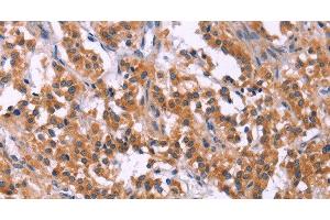 Immunohistochemistry of paraffin-embedded Human thyroid cancer tissue using MSMO1 Polyclonal Antibody at dilution 1:40 (SC4MOL 抗体)