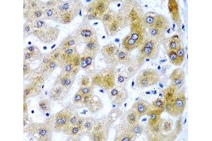 Immunohistochemistry of paraffin-embedded Human liver damage using SECISBP2 Polyclonal Antibody at dilution of 1:200 (40x lens). (SECISBP2 抗体)