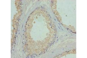 Immunohistochemistry of paraffin-embedded human prostate cancer using ABIN7152449 at dilution of 1:100