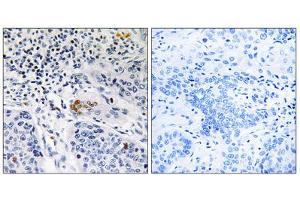 Immunohistochemistry analysis of paraffin-embedded human lung carcinoma tissue, using ZBTB40 antibody. (ZBTB40 抗体  (C-Term))