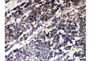Anti-Peroxiredoxin 5 Picoband antibody, (ABIN3043906), IHC(P)IHC(P): Human Lung Cancer Tissue (Peroxiredoxin 5 抗体  (AA 66-198))