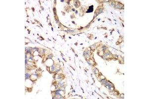 Immunohistochemistry of paraffin-embedded human liver cancer using HADHA antibody. (HADHA 抗体  (AA 484-763))