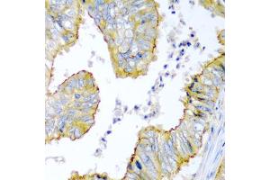 Immunohistochemistry of paraffin-embedded human colon carcinoma using KRBOX4 antibody (ABIN5975027) at dilution of 1/200 (40x lens). (KRAB Box Domain Containing 4 (KRBOX4) 抗体)